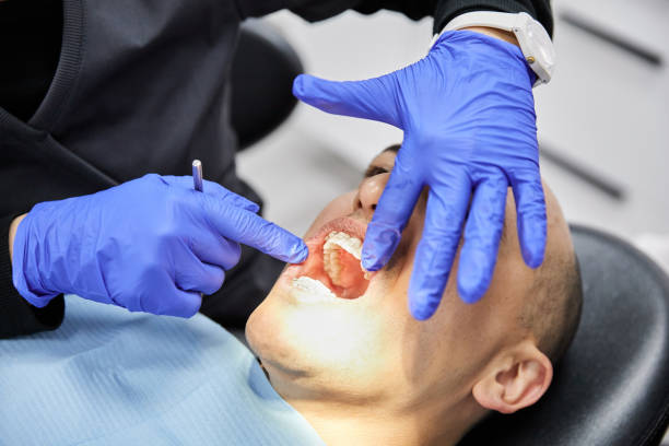 Best Emergency Wisdom Tooth Extraction in Ladera, CA
