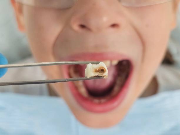 Best Broken or Chipped Tooth Repair in Ladera, CA