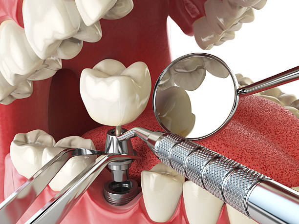 Best Knocked-Out Tooth (Avulsed Tooth) Treatment in Ladera, CA